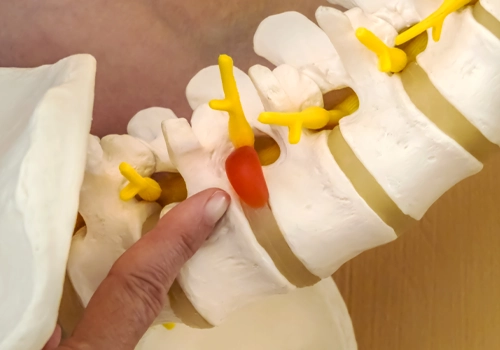 Knoxville TN Chiropractic Clinic Talks About Bulging Discs